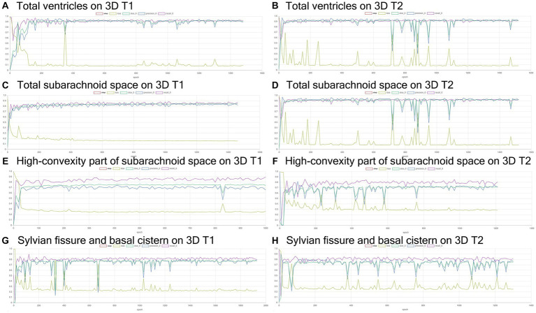 Inference results for internal validation of the semantic segmentation and image classification. The Dice scores (emerald green line), loss (lime green line), precision (blue), and recall (purple) for the automatically segmented volumes of the total ventricles (A,B), total subarachnoid spaces (C,D), high-convexity part of the subarachnoid space (E,F), and Sylvian fissure and basal cistern (G,H) on 3D T1-weighted (A,C,E,G) and T2-weighted MRIs (B,D,F,H).