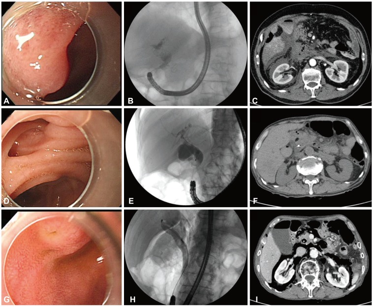 Endoscopic retrograde cholangiopancreatography findings of endoscopic view and cholangiography and computed tomography (CT) findings after perforations in three patients with Billroth II gastrectomy (A-C, patient 1; D-F, patient 2; G-I, patient 3). (A) A slit-like papillary orifice was seen in a reversed major papilla. (B) A single common bile duct (CBD) stone was seen in an angulated and narrowed distal CBD. (C) An abdominal CT showed massive fluid and air collection at the retroperitoneal space. (D) Periampullary diverticulum. (E) Distal CBD stenosis. (F) An abdominal CT revealed minimal air leak at the retroperitoneal space. (G) A papillary orifice with reversed major papilla. (H) A fluoroscopy showed a single round CBD stone and retroperitoneal air. (I) An abdominal CT showed massive air leakage without fluid accumulation in the retroperitoneal space.