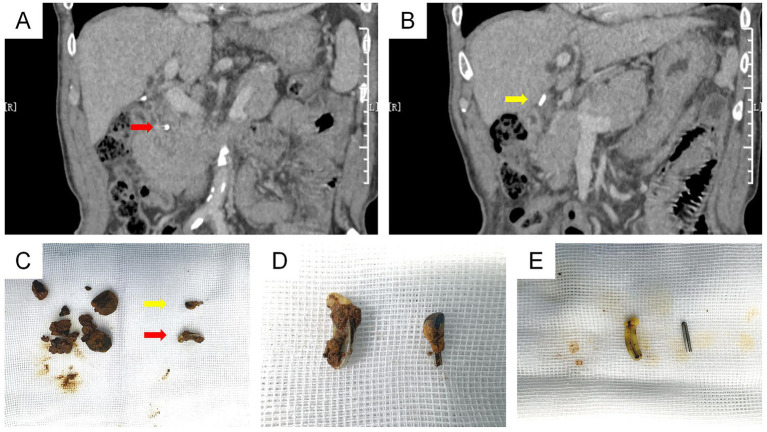 Panel A shows a medical CT scan with a red arrow indicating a foreign object or density in the abdomen. Panel B presents a similar scan with a yellow arrow highlighting another object. Panel C displays gallstones and foreign bodies on gauze, with colored arrows corresponding to those in panels A and B. Panel D highlights two foreign bodies isolated on gauze. Panel E shows two objects, one metallic and one nonmetallic, also on gauze.