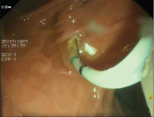 Sphincterotome introduced over the guide wire