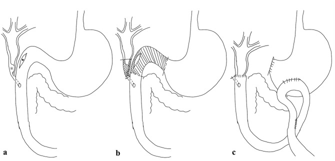 Schematic representation of the surgical procedure: (a) the mass in the common bile duct (asterisk) and the site of duodenal perforation (star); (b) diagonal lines indicating the resected areas; and (c) Billroth II gastrojejunostomy combined with Braun anastomosis and choledochoduodenostomy