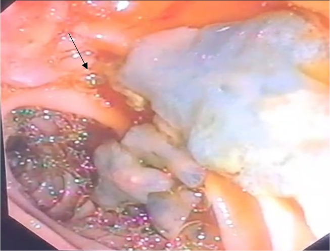ERCP showing the dilated bile ducts with alive Fasciola sp.