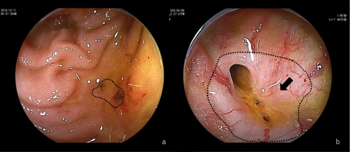 (a) Anastomosis stricture: The site of anastomosis is indicated with a dotted line. There is no bile duct mucosa between the stenotic and anastomotic regions. (b) Bile duct stenosis: There are no strictures at the anastomosis (dotted line) and bile duct mucosa (arrow) is identified between the stenotic and anastomotic regions.