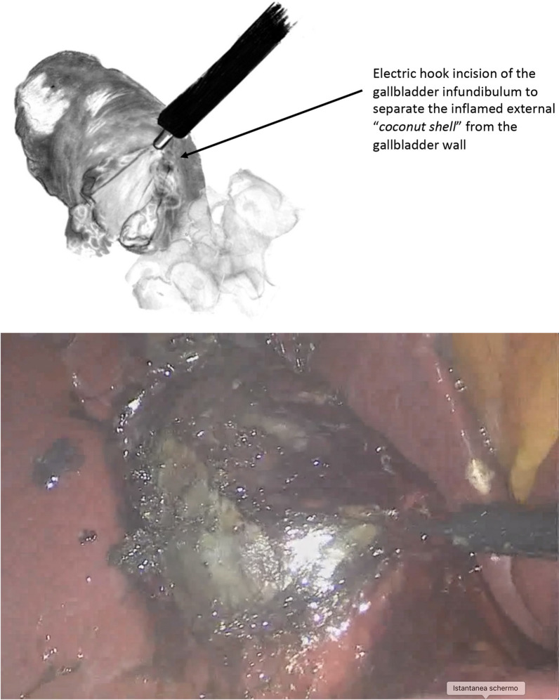Schematic drawing of the intraoperative view