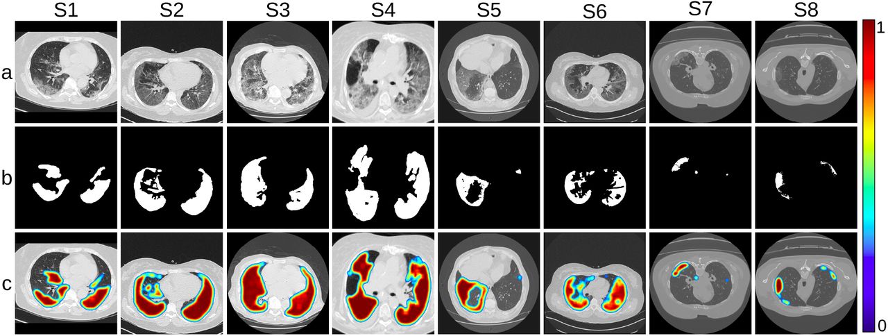 Visualization of infection, in the eight sample slices from Fig. 8, as predicted by EAMC. (a) Input CT scan, (b) corresponding annotation, and (c) JET ColorMap on the prediction