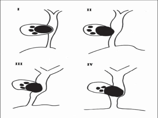 Schematic representation of Csendes classification for Mirizzi syndrome [4].