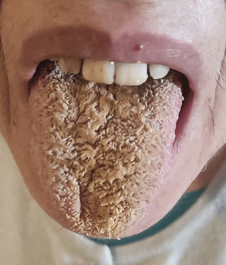 Black hairy tongue on the first day of weaning from olanzapine.Consent for publishing the image was obtained from the patient.