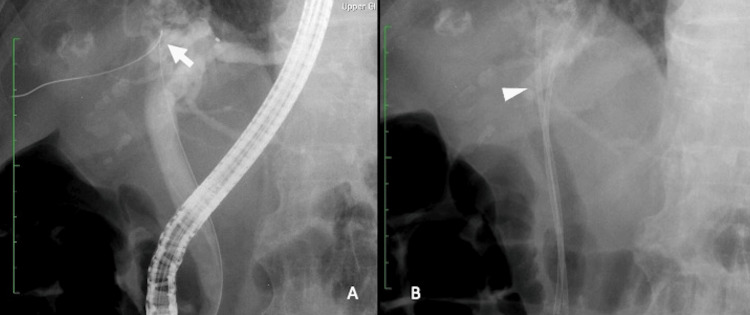 Endoscopic retrograde cholangiopancreatography (ERCP) and endoscopic retrograde biliary drainage (ERBD) treatment.Case 1. Endoscopic retrograde cholangiopancreatography (ERCP) revealed mild dilation of the common bile duct. Although an endoscopic retrograde biliary drainage (ERBD) tube was successfully placed in the common bile duct and a guidewire could be advanced into the gallbladder (A, arrow), the acute angulation of the cystic duct prevented insertion of an endoscopic retrograde gallbladder drainage (ERGBD) tube into the gallbladder; therefore, the ERGBD tube was placed at the cystic duct (B, arrowhead).