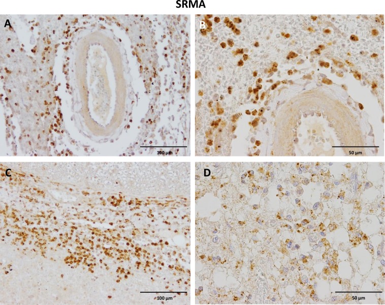 Immunohistochemistry of anti-CB2 antibody in spinal cord SRMA lesions.A) Strong CB2 positive perivascular inflammatory infiltrates surrounding meningeal blood vessels. B) The CB2 positive leukocyte population mainly consists of lymphocytes, plasma cells and fewer macrophages. C) Severe diffuse infiltration of the dura mater with CB2 positive inflammatory cells. D) Vacuolization of white matter areas with concomitant CB2 positive glial cells and leukocytes. IHC was performed using the avidin-biotin-peroxidase complex (ABC) method.