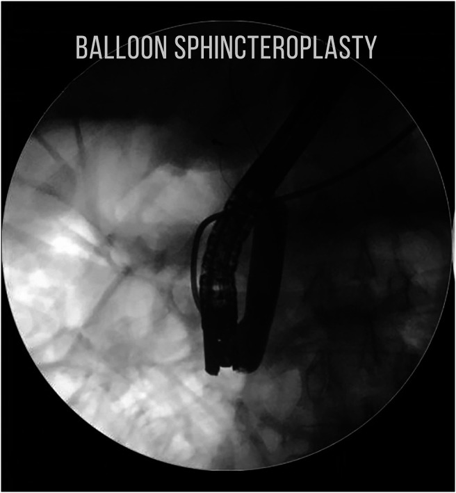 Balloon sphincteroplasty being performed after pushing the impacted Dormia basket and stone proximally.