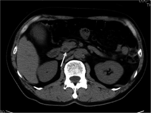 Abdominal contrast-enhanced CT showed the slightly dilated CBD and a high-density spot (arrow) in the DBD, suggesting CBD stone