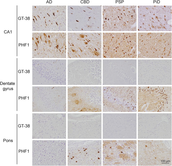 GT-38 selectively detects AD-tau pathology in the context of co-occurring FTLD-tau. IHC staining of hippocampus CA1, dentate gyrus, and pons with GT-38 or phospho-tau antibody PHF1 demonstrates that GT-38 detects tau NFTs in CA1 region but not neuronal inclusions in the molecular layer of the dentate gyrus present in FTLD-tau. GT-38 does not detect neuronal or astrocytic tau pathology in pons of FTLD-tau cases verifying selectivity of GT-38 for AD-tau pathology