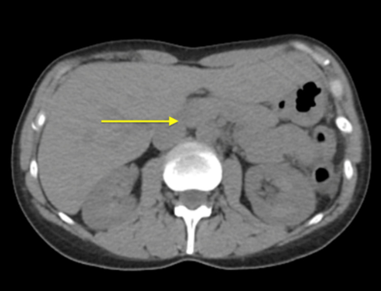Computerized tomography (CT) abdomen/pelvis without contrast shows mild fat stranding present in the region of the pancreas consistent with acute pancreatitis.