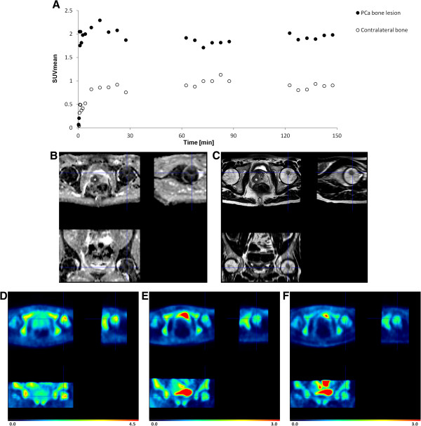Kinetics of 18F-MK-9470 in a bone metastasis. 18F-MK-9470 uptake in a lesion of the left femoral head versus 18F-MK-9470 uptake in contralateral normal bone tissue of patient 5 (A). The DWI MRI (B) and the T2w MRI (C) images show a low-signal-intensity mass in the lesion of the left femoral head as well as the local tumour (indicated with an asterisk). Integrated PET images of the first (D), second (E) and third (F) acquisition time interval demonstrate increased 18F-MK-9470 uptake in the bone metastasis as compared to that of the contralateral bone. Note the absence of 18F-MK-9470 uptake in the local PCa visible on the MRI images. Data are scaled from 0 to 4.5 SUV in (C) and scaled form 0 to 3.0 SUV in (D) and (E).