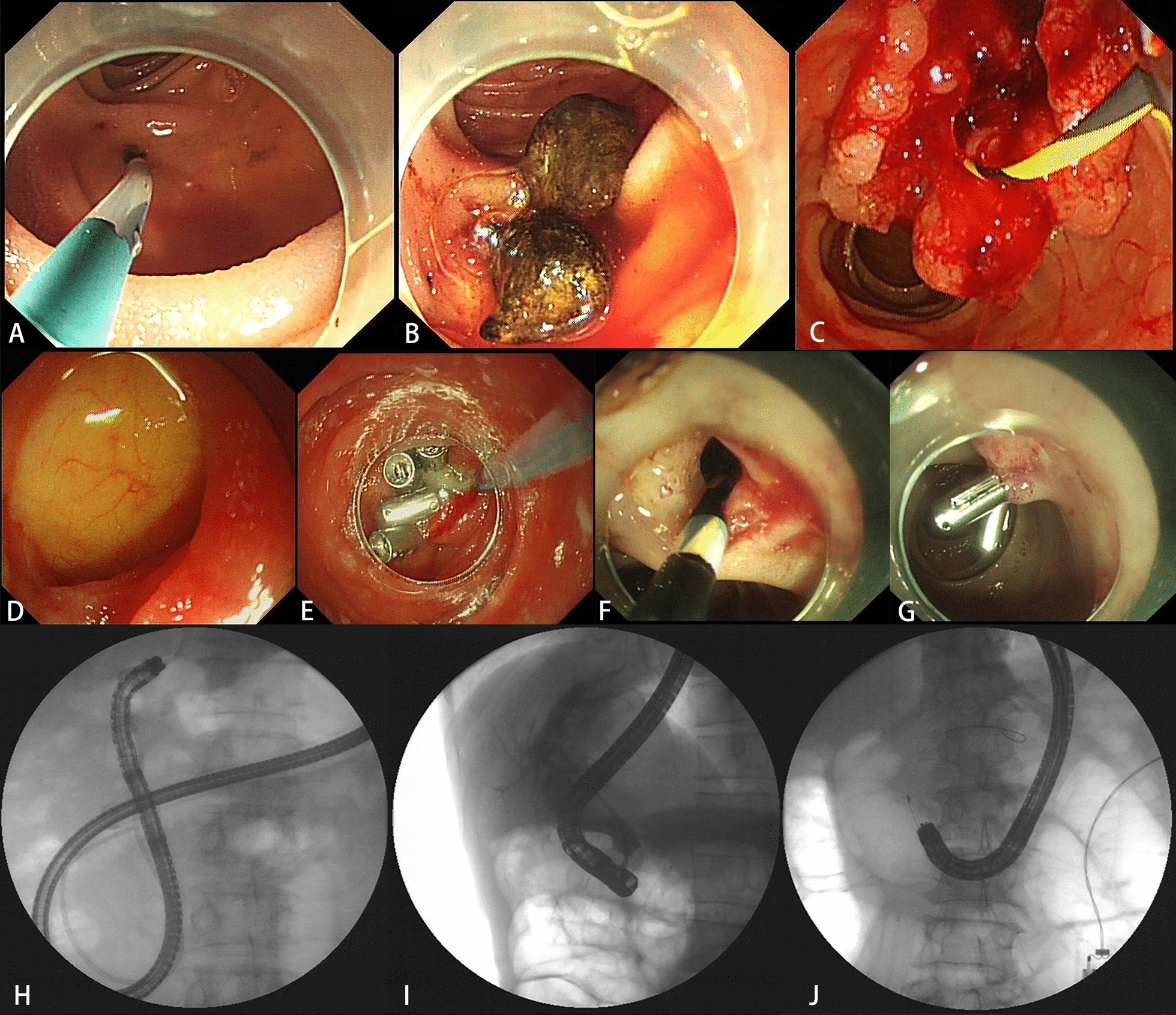 ERCP procedure. A A surgical anastomosis was reached in a patient who had underwent pancreaticoduodenectomy. B Common bile duct stones were detected. C Biopsy was performed in a case of bile duct cancer. D A perforation occurred in the acute angulation of the afferent loop. E The perforation was treated with purse string suture endoscopically. F A case of delayed bleeding occurred. G The delayed bleeding was treated with emergency endoscopic hemostasis using balloon compression and hemostatic clips. H A short-type single-balloon enteroscope was used. I A duodenoscope was used. J A standard colonoscope was used