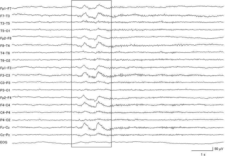 Electroencephalogram of a patient with idiopathic Parkinson's disease, demonstrating generalized delta slow wave activity (within box).