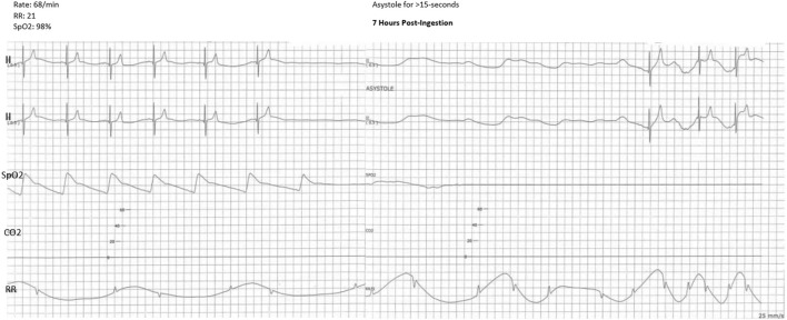 Telemetry strip showing asystole for >15-s.