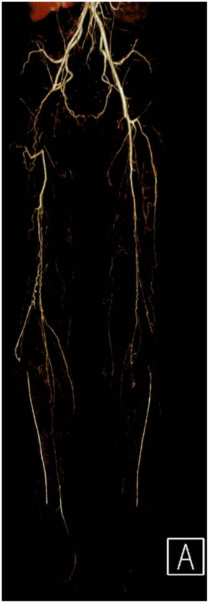 Three-dimensional reconstruction of the patient’s computed tomography angiography with bilateral lower extremity runoff. Note the right superficial femoral artery occlusion with distal reconstitution of the anterior and posterior tibial arteries.