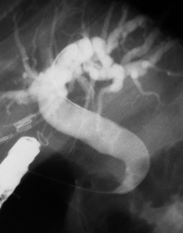 Cholangiography of a typical case. Characteristic appearance of CBD with tapered and hook-shaped distal ending in a patient with ectopic opening to the duodenal bulb. Note the dilation at CBD and intrahepatic bile ducts.