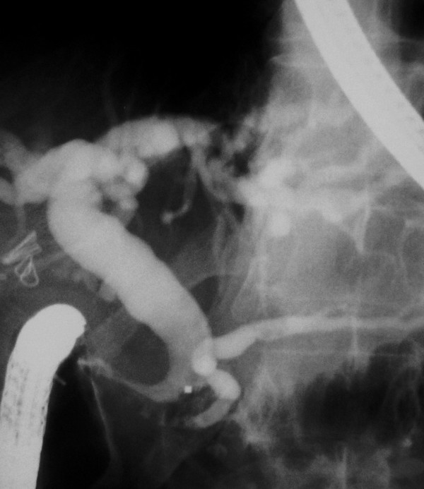 Cholangiography of a case with "Real Stricture". A dilated CBD and PD separately opened to the duodenal bulb. Note the distal end of the CBD narrowed critically. Despite the absence of a stone, a 11.5 mm diameter inflated extraction balloon wasn't pulled-out.(real stricture).