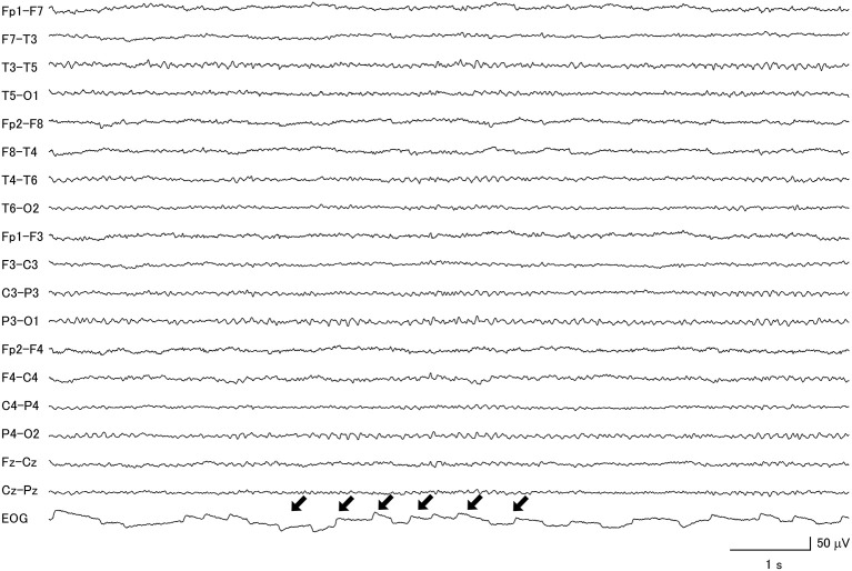 Macro-square-wave jerks (black arrows) were detected on the electro-oculogram of a patient with progressive supranuclear palsy.