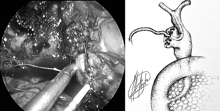 Closure of CBD over cholangiocatheter