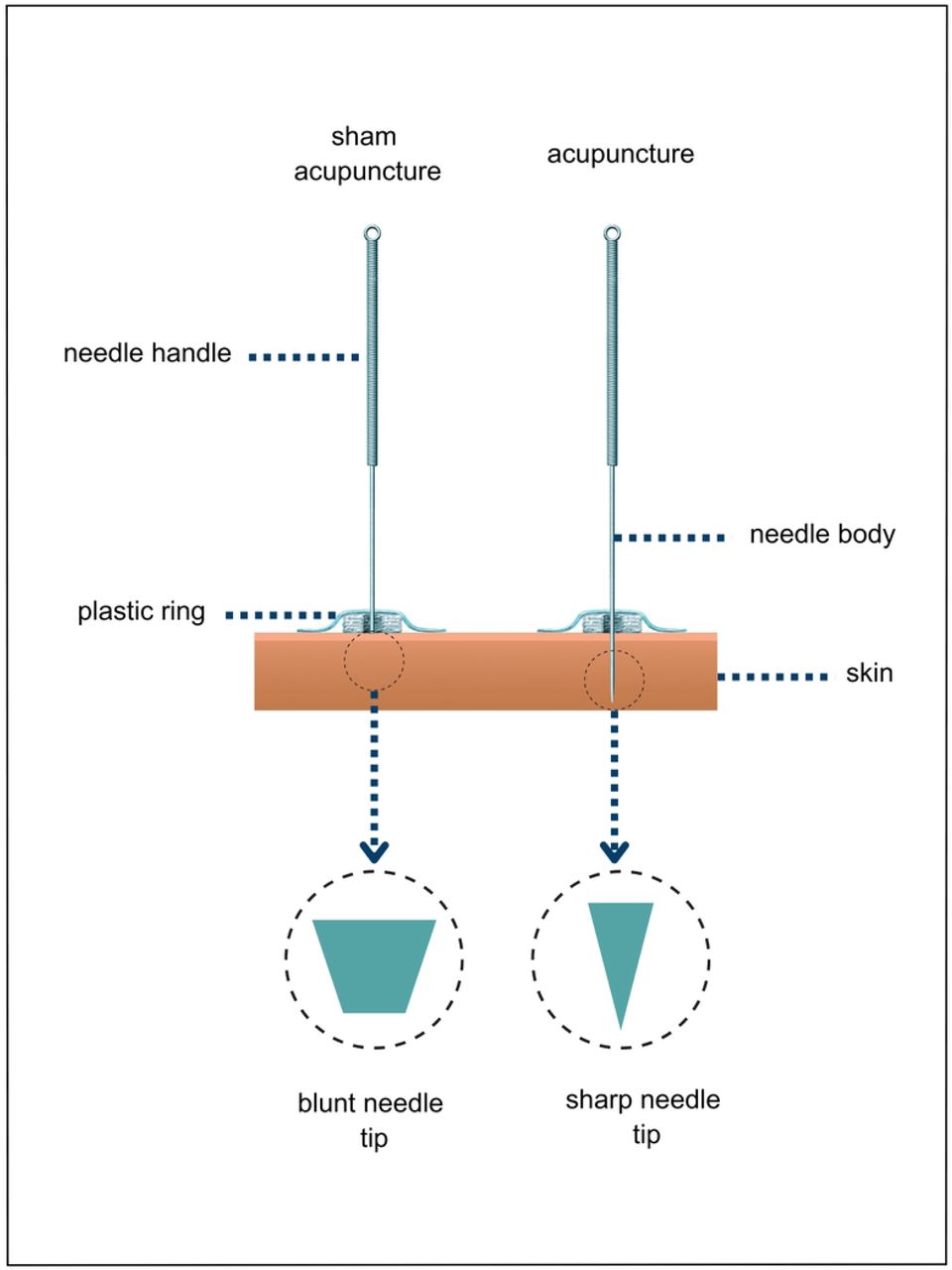 Scheme of acupuncture and sham acupuncture needles