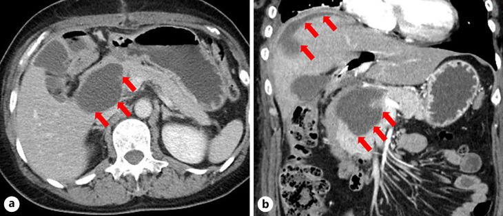 CT on the 10th POD revealed PF. Fluid retention with a maximum diameter of 58 mm near the upper edge of the head of the pancreas and the anterior surface of the right lobe of the liver is observed (arrow). a Axial section. b Coronal section.