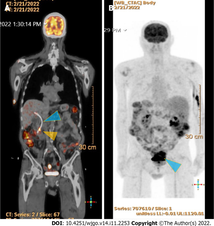 18F-Flurodeoxyglucose positron emission tomography scan studies. A: Shows an end-obiliary stent in the region of the papilla (blue triangle) and a 1.7 cm ampullary mass with intense fluorodeoxyglucose (FDG) avidity(yellow triangle); B: Shows an oval-shaped, well-defined, FDG-avid lesion measuring approximately 6 cm × 3 cm with a small, punctate area of calcification was present in the lesion located deep in the pelvis along the posterior margin of small bowel loops (blue triangle) with intense FDG avidity.