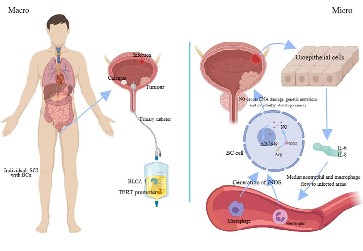 A sketch of the pathogenesis: bladder cancer in patients with spinal cord injury