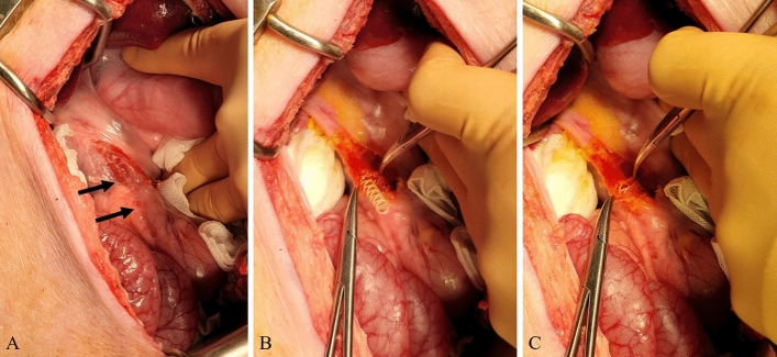 Stent placement in the common bile duct (CBD). (A) Identification and exposure of the CBD (arrows). (B,C) Transverse incision of the CBD and stent insertion.