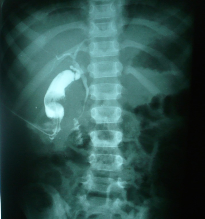 Figure 4: Tube cholangiogram showing free flow of contrast into the duodenum.