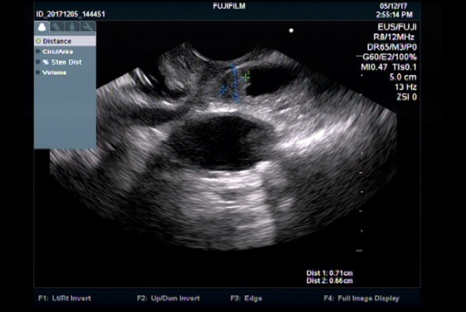 Endoscopic ultrasound image demonstrating a mixed echogenic structure in the distal common bile duct.