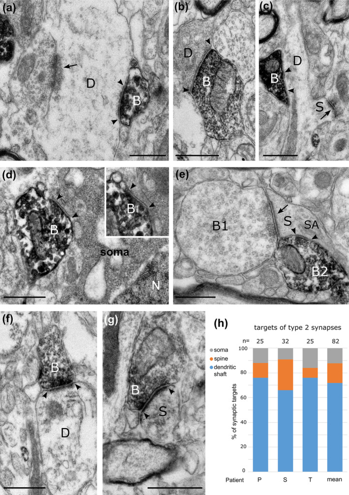Electron micrographs of the synaptic targets and quantitative distribution of CB1 cannabinoid receptor expressing nerve terminals in layers 2–3 of the human cerebral cortex. Immunoperoxidase reactions show CB1‐positive terminal boutons (B) filled with electron‐opaque DAB‐deposit (black); the synaptic junctions are marked by arrowheads. (a)–(c). Dendritic shafts (D) receive type‐2 synapses from CB1‐positive boutons. In (a), a large dendrite also receives a type‐1 synapse (arrow) from an unlabelled bouton. In (c), the dendrite emits a sessile spine (S), which receives a type‐1 synapse. (d). A CB1‐positive bouton innervates a neuronal soma (N, nucleus); inset, the same synapse in a serial section. (e) A dendritic spine (S) with spine apparatus (SA) receives a type‐1 synapse from a large bouton (B1) and a type‐2 synapse from a CB1‐positive bouton (B2). (f, g) CB1‐positive boutons making type‐1 synapses innervate a dendritic shaft (D) and a dendritic spine (S). The HRP reaction‐product is concentrated at the presynaptic active zones. (h). Distribution of the synaptic targets of CB1‐positive boutons making type‐2 synapses in three patients (P,S,T, and average); the majority of synaptic targets are dendritic shafts. Images (a, c, f, g) patient T, right inferior frontal gyrus; images (b, d) patient S, left middle temporal gyrus; image (e), patient P, right inferior temporal gyrus. Scale bars: 0.5 μm.