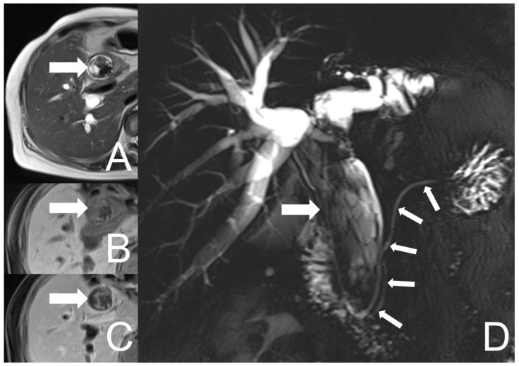 UCOGC of CHD and CBD in a 66-year-old female, 10 months after the initial presentation. The tumor (thick arrow) shows an increase in size with more conspicuous cystic parts on the axial T2-weighted image (A), and more conspicuous heterogeneous signal intensities and enhancement on the axial pre- and post-contrast T1-weighted fat-saturated images (B,C). The hypointensities of the lesion on both T1- and T2-weighted images could be suggestive of hemosiderin deposition. The MRCP (D) reveals the tumor occupying the whole CHD and CBD, with the dilatation of the biliary tract. Neither tumor involvement nor dilatation of the pancreatic duct were found (thin arrows).