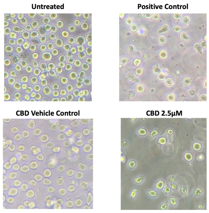 CBD induces apoptotic morphology in Jurkat cells. Photomicrographs (20×) of Jurkat cells following 24 h treatment with 2.5 μΜ CBD. Note marked changes in cell morphology at 2.5 μM compared to vehicle control, similar to cellular morphology seen in the positive control (150 mM ethanol).