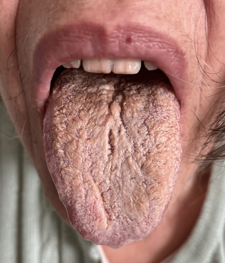 Black hairy tongue on the 15th day of weaning from olanzapine.Consent for publishing the image was obtained from the patient.