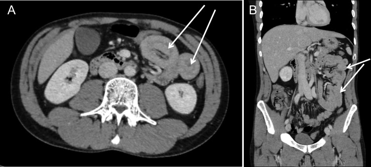 Computed tomography revealed presence of several jejuno-jejunal intussusceptions in axial (A) and coronar (B) images.