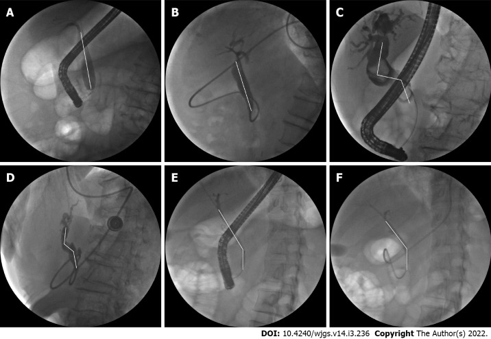 Common bile duct morphology on cholangiograms. A, B: Straight type; C, D: S type; E, F: Polyline type.