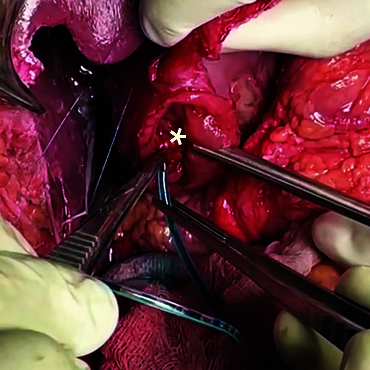 After duodenotomy, the ampulla was identified and cannulated using an IFT; left upper quadrant of the image showed part of the liver; (* represented to ampulla in second part of duodenum)