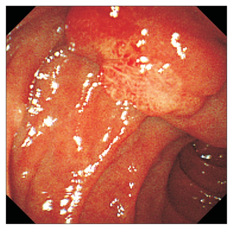 Esophagogastroduodenoscopic finding. A mass with rough and reddish mucosa is located at the ampulla of Vater.
