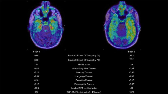 [18F]MK‐6240 PET‐MR fused images of the two (out of nine) subjects diagnosed with frontotemporal dementia (FTD) and presenting significant neocortical signal. Quantitative [18F]MK‐6240 PET data, cognitive tests results, Amyloid PET, and CSF results are displayed. Braak ≤ 2: Region corresponding to the mesiotemporal lobe. Braak ≤ 6: Region corresponding to the whole neocortex and some gray nuclei. CSF, cerebrospinal fluid; MMSE, mini‐mental score examination.