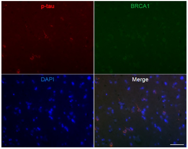 Immunofluorescence double staining of progressive supranuclear palsy cerebral white matter. Multiple p-tau positive glial coiled bodies are seen, which mostly show colocalization of BRCA1. The scale bar represents 50 µm.