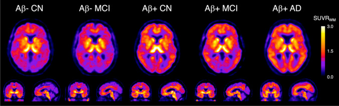 [18F]SMBT-1 PET images in AD and cognitive normal subject. This research was originally published in JNM. Villemagne VL, Harada R, Dore V, Furumoto S, Mulligan R, Kudo Y, et al. Assessing Reactive Astrogliosis with 18F-SMBT-1 Across the Alzheimer Disease Spectrum. J Nucl Med. 2022;63:1560-9. © SNMMI
