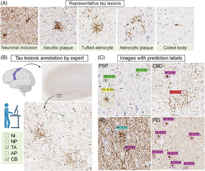 Object detection model. (A) Representative CP13‐immunostained images of five tau lesions. (B) Annotation of the representative tau lesions. A total of 2522 images are manually annotated by an investigator using LabelImg. (C) Representative results of prediction. Detected tau lesions are shown with bounding boxes with predicted labels. The number indicates the probability of each label. Abbreviations: AD, Alzheimer's disease; AP, astrocytic plaques; CB, coiled bodies; CBD, corticobasal degeneration; NI, neuronal inclusions; NP, neuritic plaques; PiD, Pick's disease; PSP, progressive supranuclear palsy; TA, tufted astrocytes