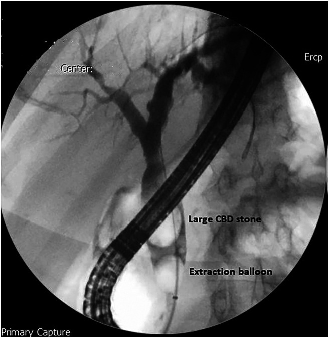 Cholangiogram showing an impacted large common bile duct stone.
