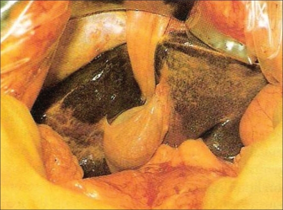 Gall bladder on left side of the falciparum ligament
