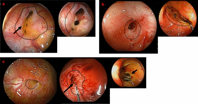 (a) Strictures diagnosed as “bile duct strictures.” No strictures at the anastomosis (dotted line) and bile duct mucosa (arrow) are found between the stenotic and anastomotic regions. The figure on the right shows the bile duct after balloon dilatation of strictures (narrowed bile duct) with DBERC. (b) Stricture diagnosed as an “anastomotic stricture.” The site of anastomosis is indicated with a dotted line. There is no bile duct mucosa between the stenotic and anastomotic regions. The figure on the right shows the bile duct after balloon dilation of the stenotic anastomosis. There are no strictures at the bile duct. (c) Strictures diagnosed as “anastomotic and bile duct strictures.” The anastomosis site is indicated with a dotted line. There is no bile duct mucosa between the stenotic and anastomotic regions. The stricture was diagnosed as an “anastomotic stricture.” The figure in the middle shows the bile duct after dilation of the anastomosis, bile duct strictures (arrow) are also seen. The figure on the right shows the bile duct after balloon dilation of the narrowed segment of the bile duct (arrow). DBERC double-balloon endoscopic retrograde cholangiography.