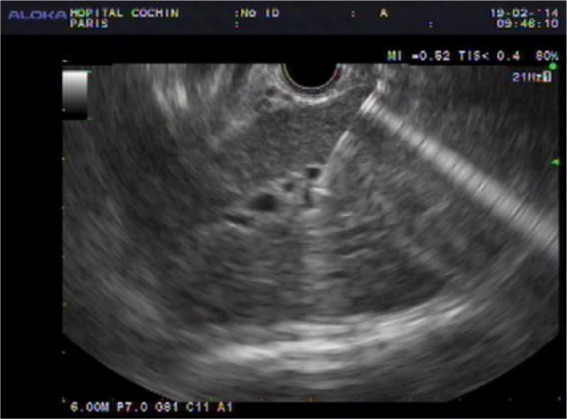 Biliary puncture under endoscopic ultrasound control.