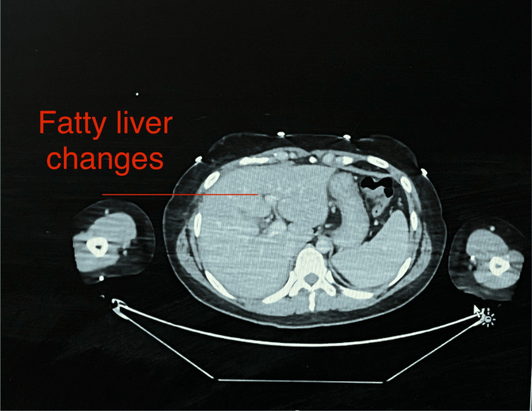 CT Images showing fatty liver .